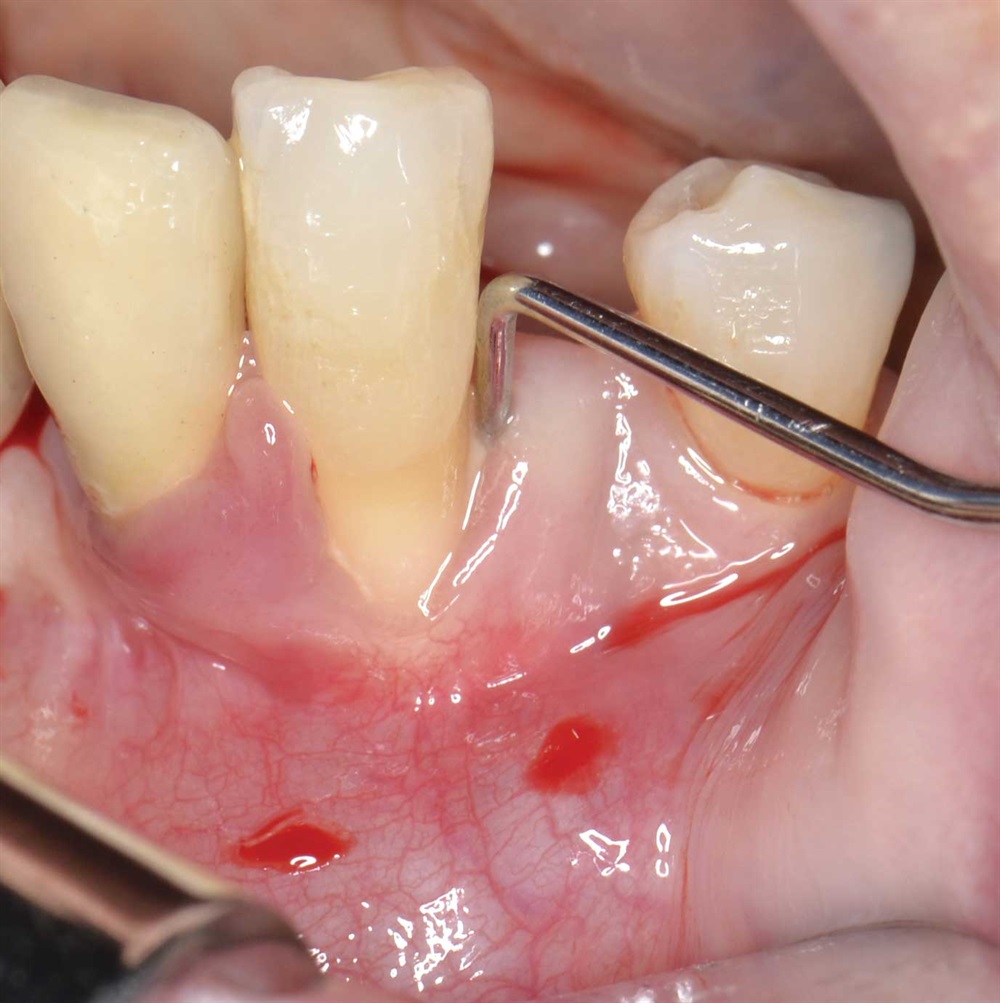 Tarquini_Periodontal intrabony defect